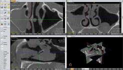 Orthogonal MPR